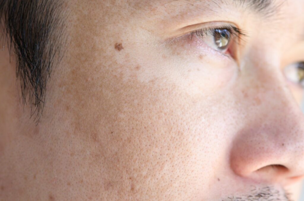 Hyperpigmentation converted 1