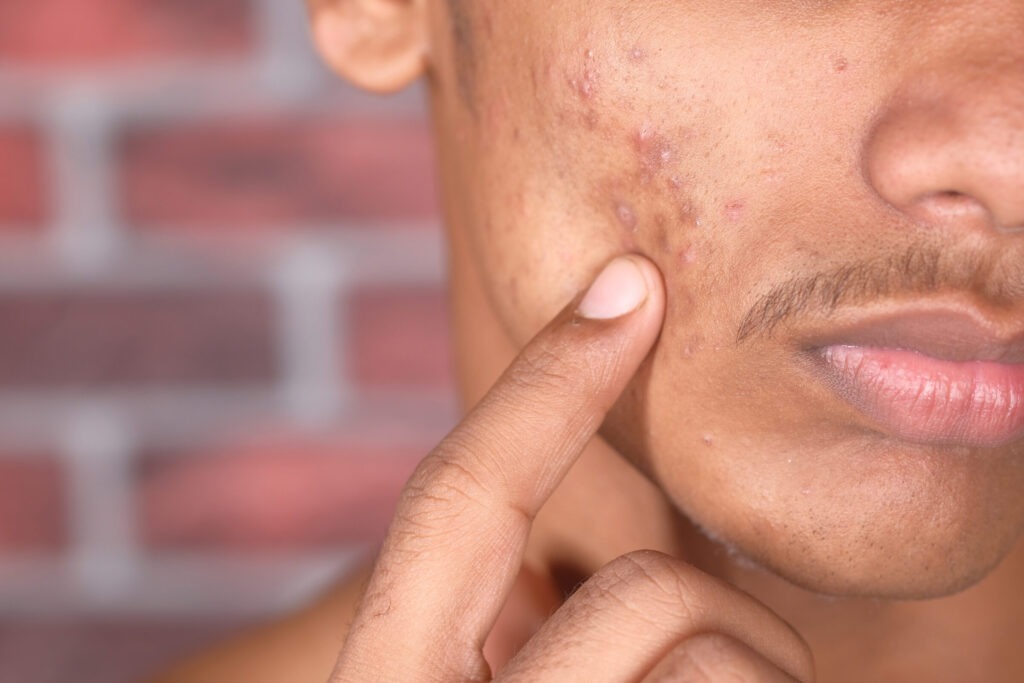 Acne Scarring 1 close up of young man face with skin problem 2024 12 13 06 56 50 utc
