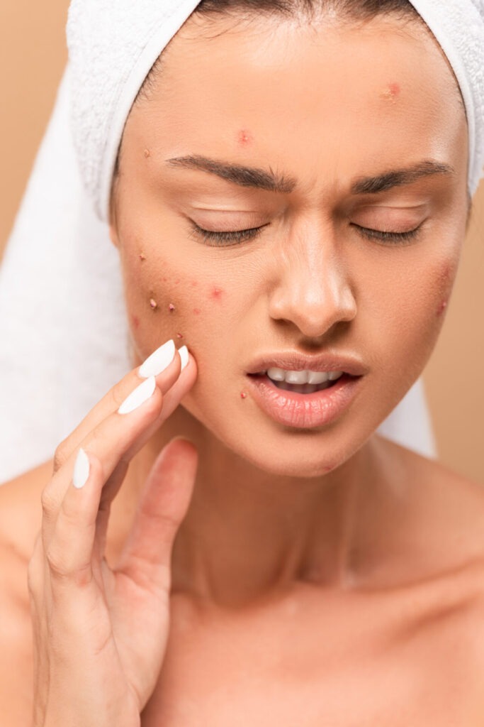 displeased nude girl in towel touching acne on fac 2024 11 12 15 35 02 utc