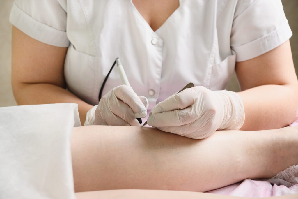 removal hair from womans legs by electro epilation 2025 03 10 11 46 06 utc